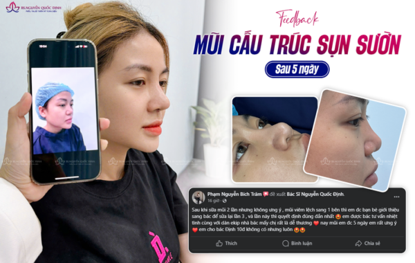 Hậu phẫu thuật nâng mũi, bác sĩ thẩm mỹ cảnh báo dấu hiệu bất thường