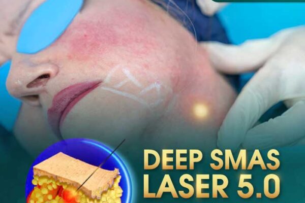 Căng Da Mặt Deep Smas Laser 5.0