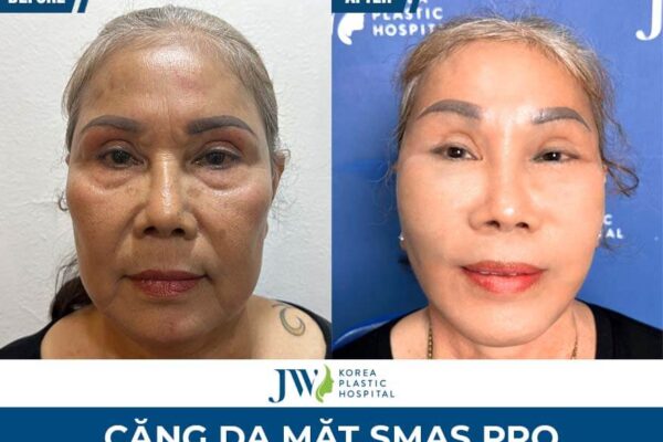Căng Da Mặt Smas