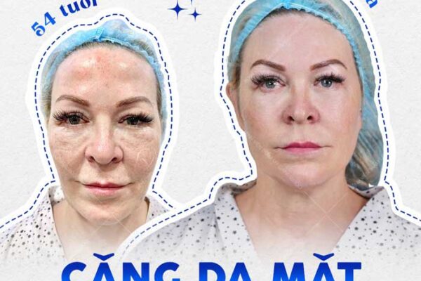Căng Da Mặt Trẻ Hóa Bằng Chỉ Firin Nano Collagen