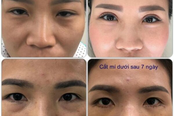 Cắt Mí Mắt