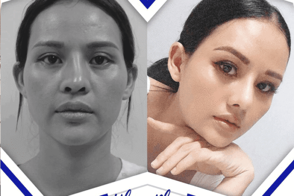 Chỉnh Dị Tật Mũi