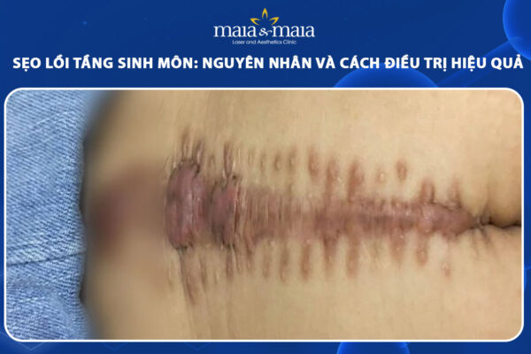 Chỉnh Sẹo Xấu Tầng Sinh Môn