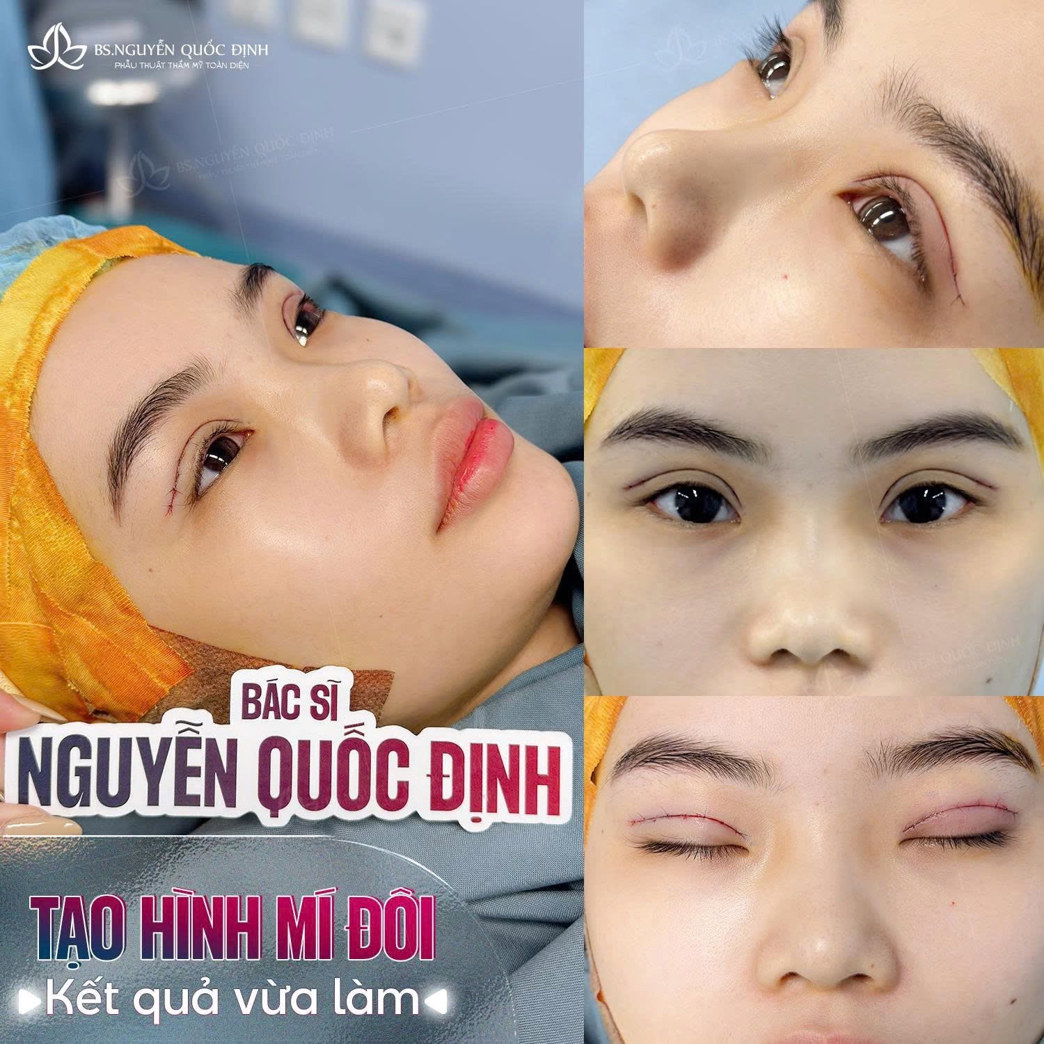 Chị Hoàng Oanh (29t, Cần Thơ) – Kích mí đôi