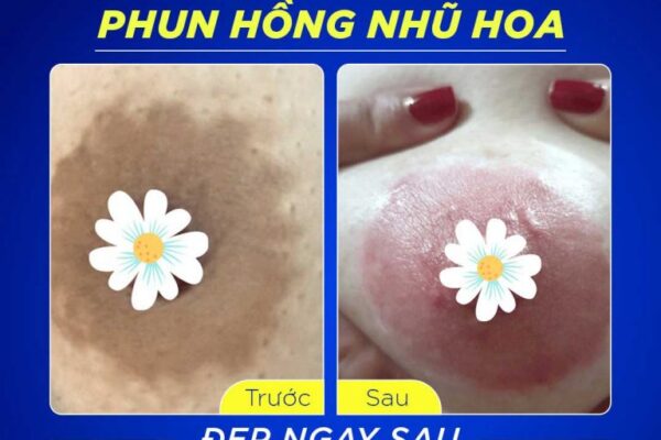 Làm Hồng Nhũ Hoa