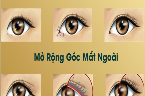 Mở Rộng Góc Mắt Ngoài Và Trong