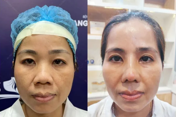 Nâng Cung Chân Mày Nội Soi