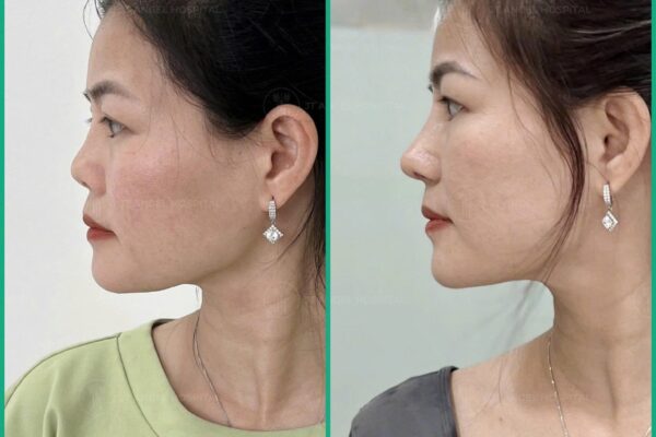 Nâng Mũi Bọc Sụn Tự Thân