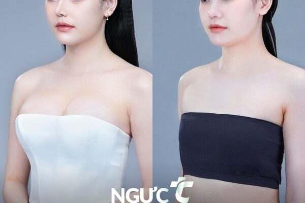 Nâng Ngực Tissue Preservation