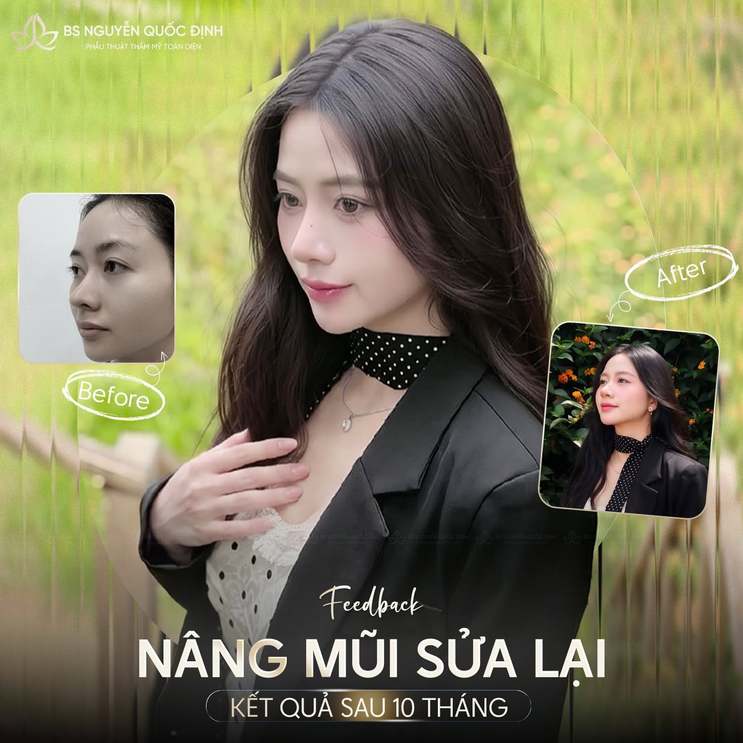 Chị Thu Hằng (32t, Hà Nội) – Nâng mũi sửa lại