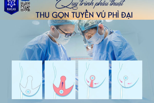 Thu Nhỏ Vú Phì Đại
