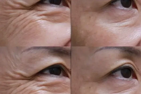 Xóa Nhăn Đuôi Mắt